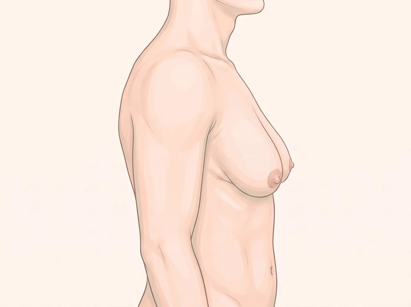 3등급 옆모습 그림 — 유선 증식이 심하고 피부 처짐 동반